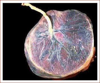 轮廓胎盘及有缘胎盘