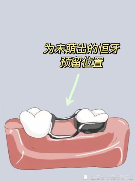  p>间隙保持器是指儿童牙齿在早失后,为了保持这个空缺,维持正常的