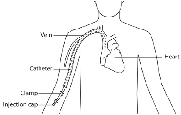 经外周静脉穿刺中心静脉置管