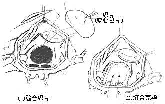 继发性心房间隔缺损_百度百科