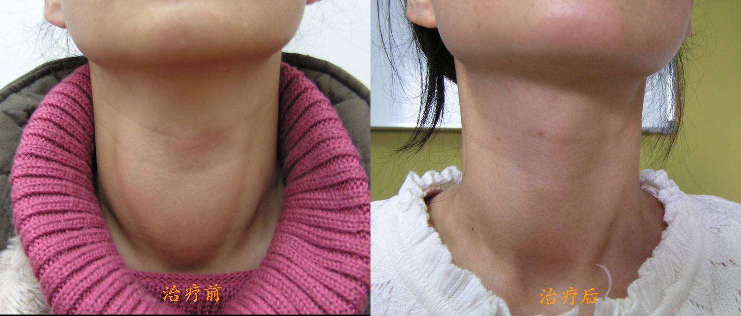  p data-id="gnx5e0bsrc">碘过量近年来受到了国际甲状腺学界和地方病