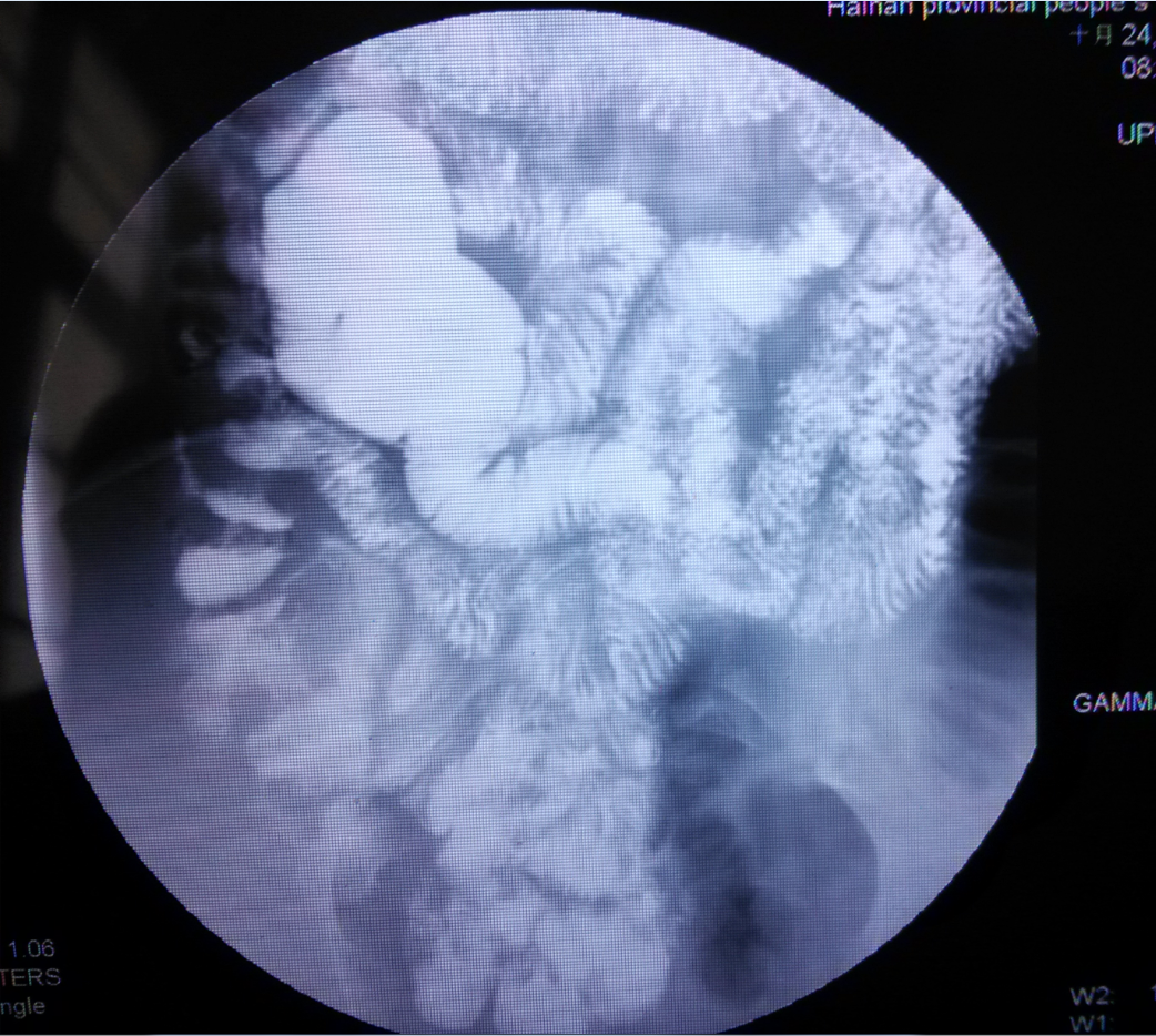  p>全消化道造影,医学术语,是指把食道,胃及小肠结肠至直肠进行钡餐