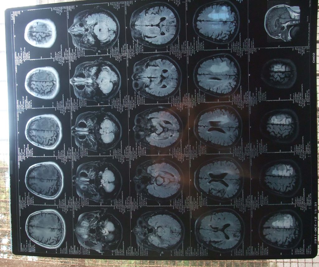  p>脑腔梗是一种病症名称,属于 a href="#" data-lemmaid="658362">