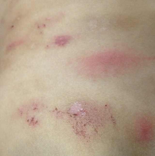  p>高蛋白过敏是 a target="_blank" href="/item/人体免疫系统