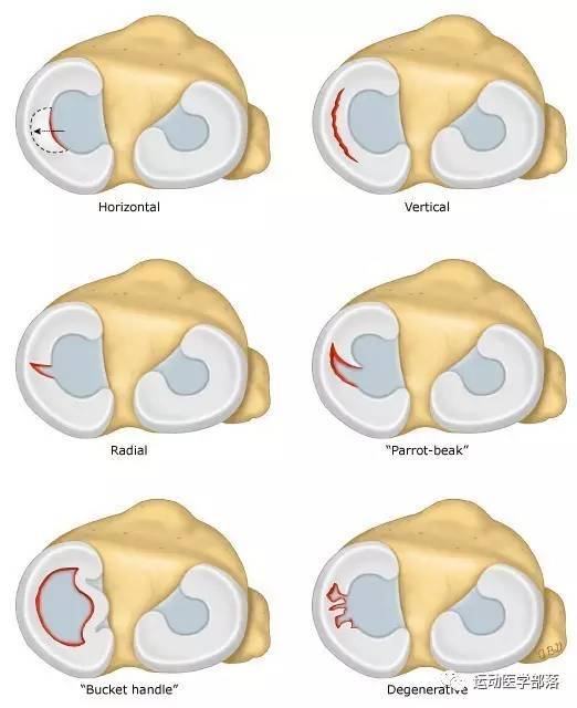  p>盘状半月板又称盘状软骨,是指半月板的形态异常,较正常的半月板大