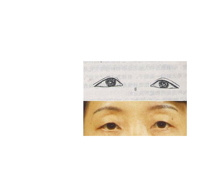 data-lemmaid="362">眼睛 /a>形状之一,眼型如同倒三角