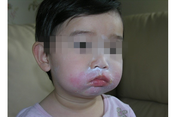 因食用芒果而出现的过敏症状大多类似,嘴唇肿胀,脸部皮肤