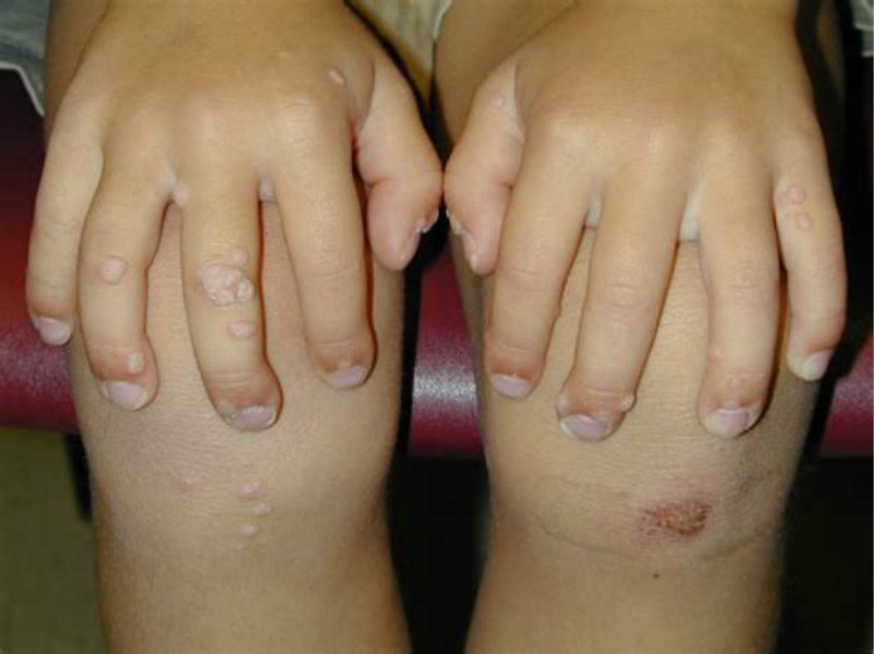 acuminatum,ca)系人类 a target="_blank" href="/item/乳头瘤