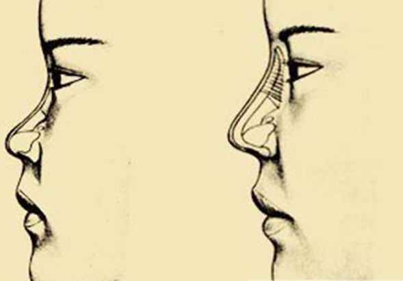  p>人们常说的塌鼻梁,又称 a href="#" data-lemmaid="6021122">鞍鼻 