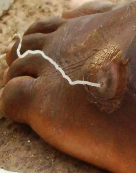  p>麦地那龙线虫 dracunculus medinensis,是唯一的主要由饮用水传播