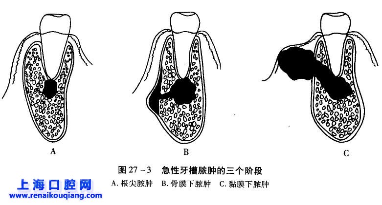 急性根尖周炎是从根尖周牙周膜由浆液性 a href="#" data-lemmaid="