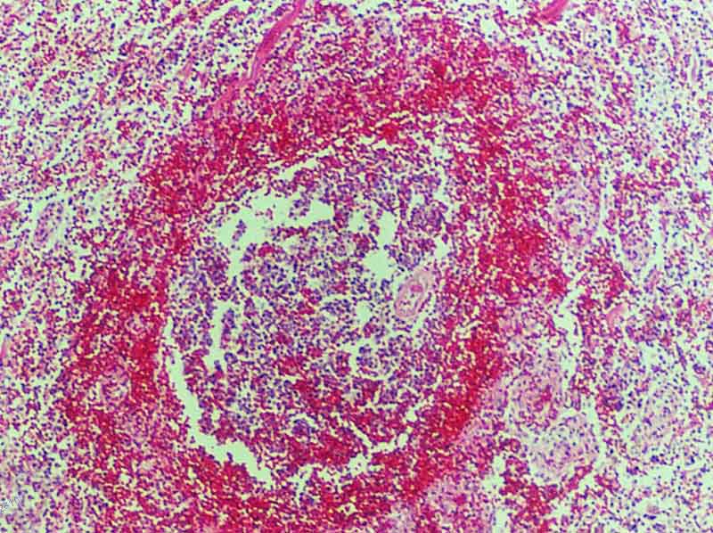 溶血性链球菌感染
