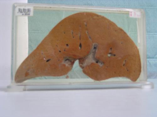 包括乙肝,甲肝,丙肝, a href="#" data-lemmaid="184621">肝硬化 /a>