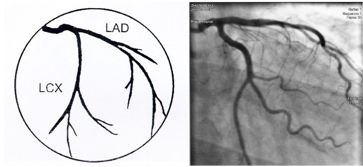 冠状动脉造影是诊断冠状动脉粥样硬化性心脏病(冠心病)的一种常用而且