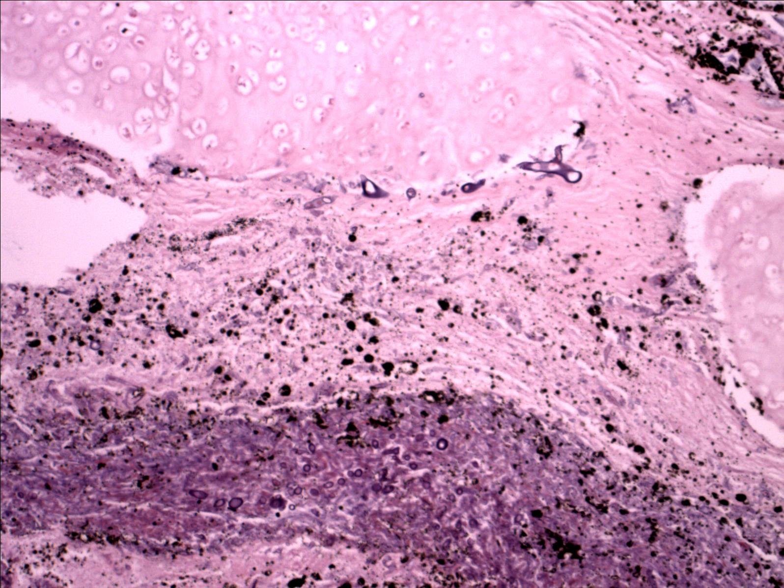 pulmonarymucormycosis