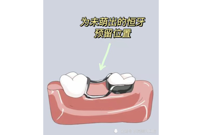 间隙保持器