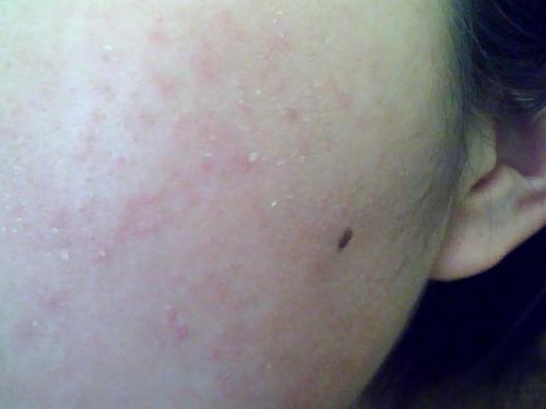 ">皮肤过敏 /a> a href="#" data-lemmaid="1507127">症状 /a>是发痒