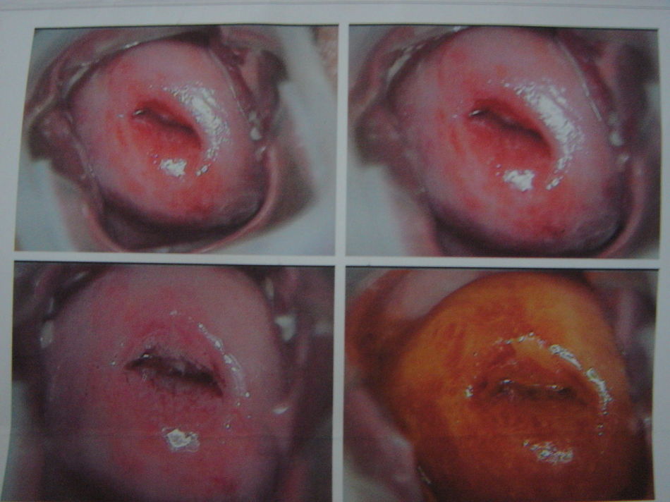 排卵期白带带血