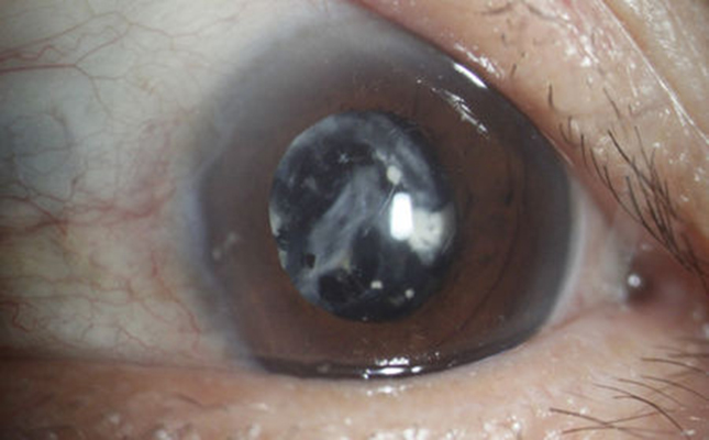 data-lemmaid="248056">白内障 /a>的主要症状表现为视力减退和 a