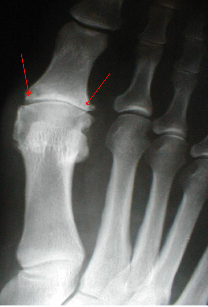  p data-id="sovgmno7zfeo">跖趾关节属椭圆关节,可作屈伸及轻微的收