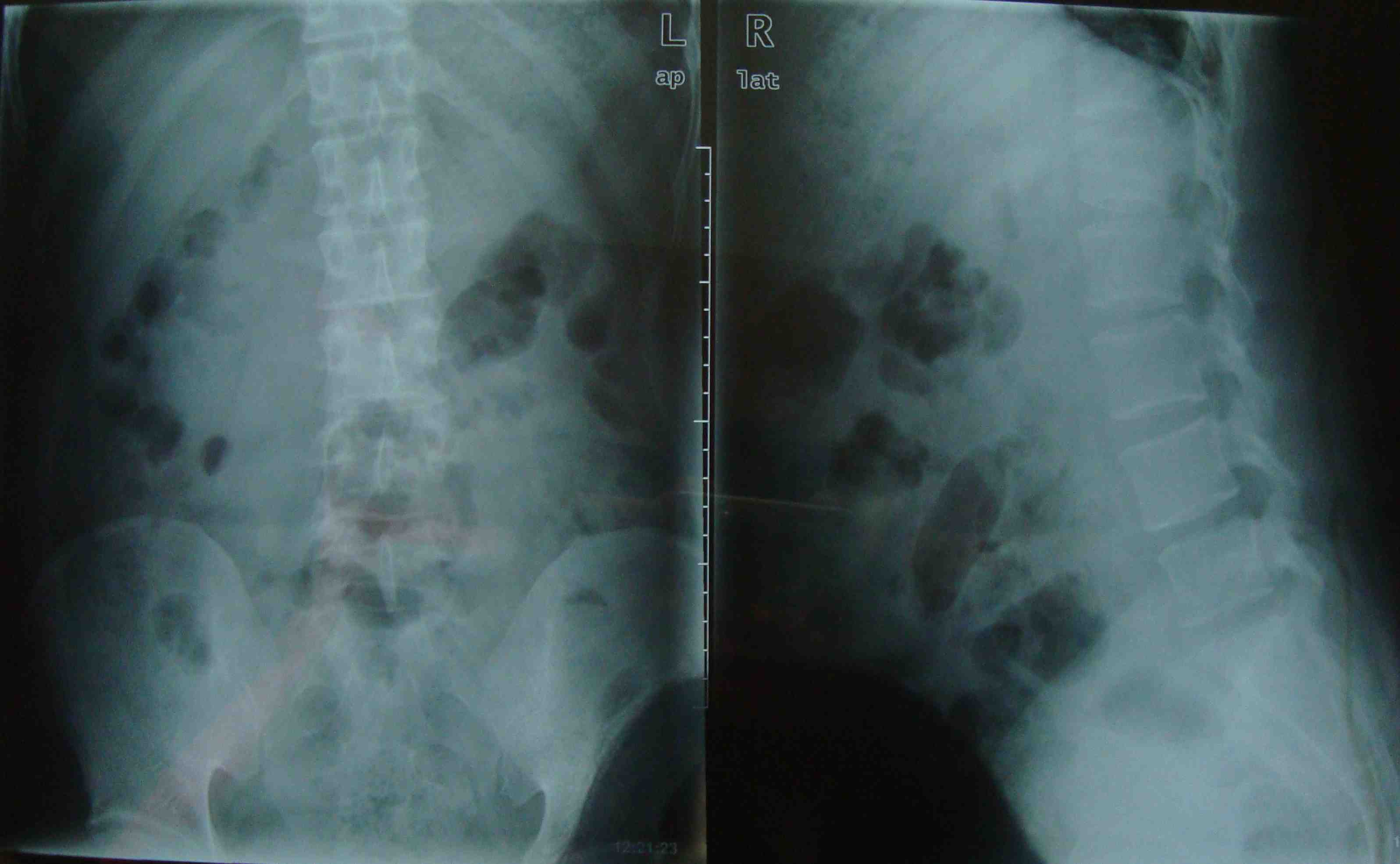 腰椎生理曲度变直