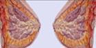 乳腺小叶增生症