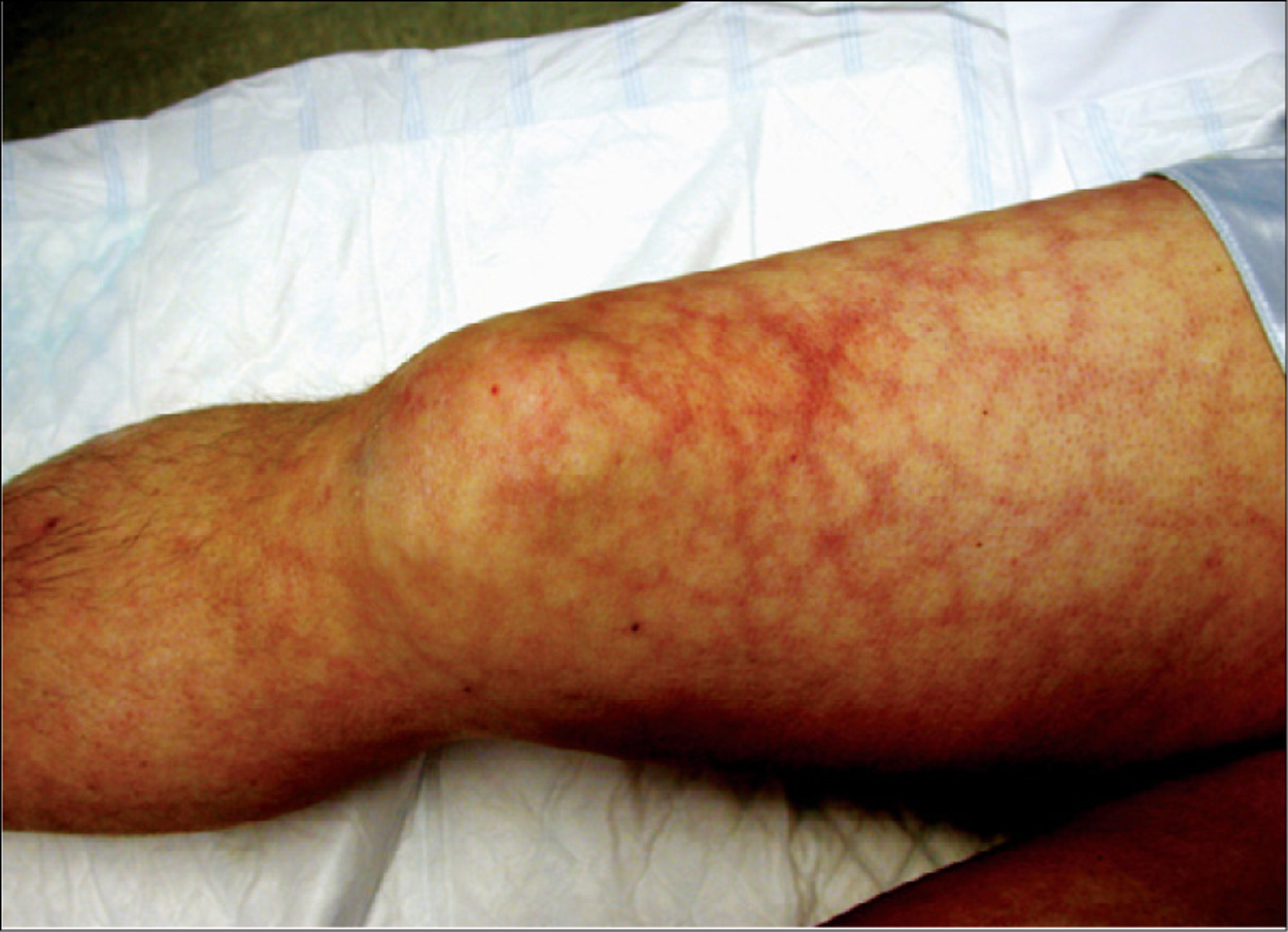  p>抗磷脂抗体综合征又称hoghes综合征,是一种以反复发生的血栓形成