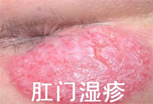 肛门湿疹