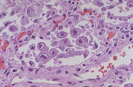  p>巨细胞病毒(cytomegalovirus)是一种 a href="#">疱疹病毒 /a>组