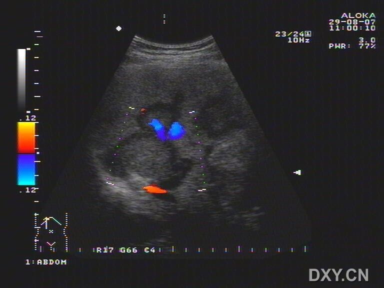  p>牛眼征是指肝脏 a target="_blank" href="/item/继发性肿瘤