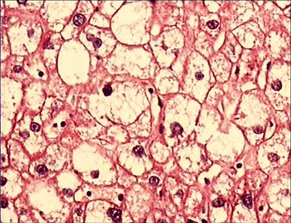 胞浆疏松化,进一步发展肝细胞胀大如球形,胞浆几乎透明,称为气球样变