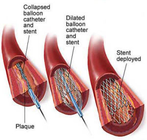  p>心脏支架(stent)又称 a href="#">冠状动脉 /a>支架,是 a href="#"