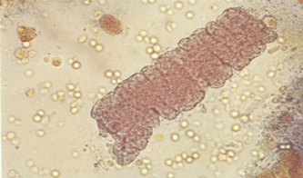  p data-id="go0ai2typ5">蜡样管型,又称蜡状管型,由颗粒管型,细胞管