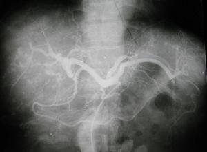 肝脏恶性血管瘤