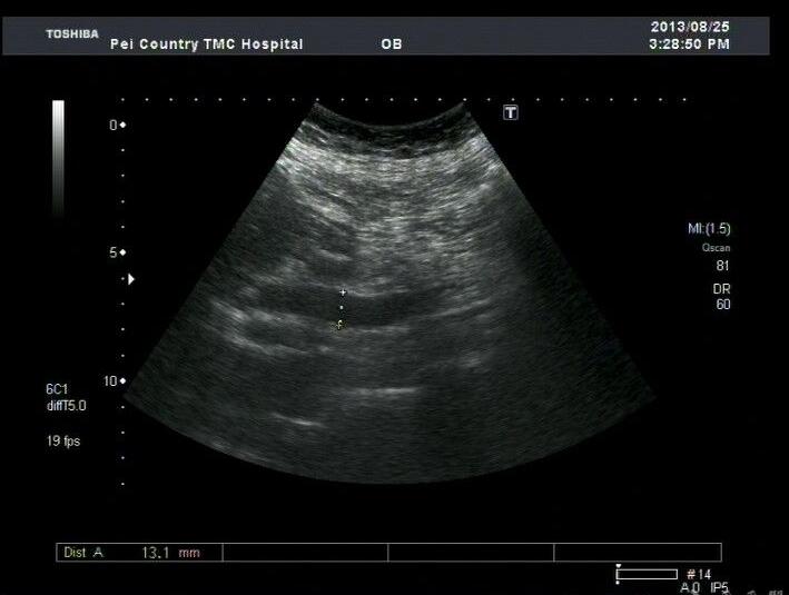 ">胆管扩张症 /a>为较常见的先天性胆道畸形以往认为是一种局限于 a