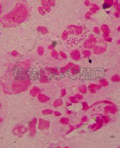  p>细菌性 a target="_blank" href="/item/脑膜">脑膜 /a>炎是一类