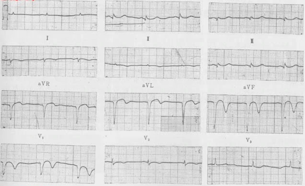陈旧性心肌梗塞
