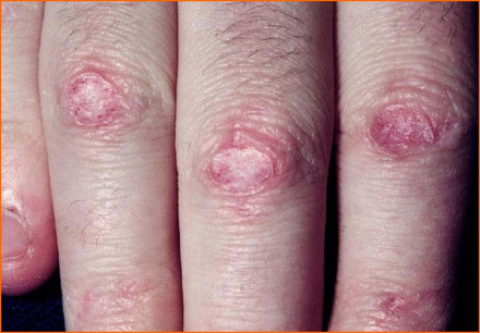 Gottron丘疹_百度百科