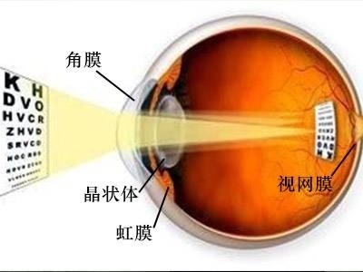 irregular astigmatism