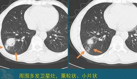  p data-id="gnvixk8lsl">又称肺结核瘤,它不是一种肿瘤,只是 a