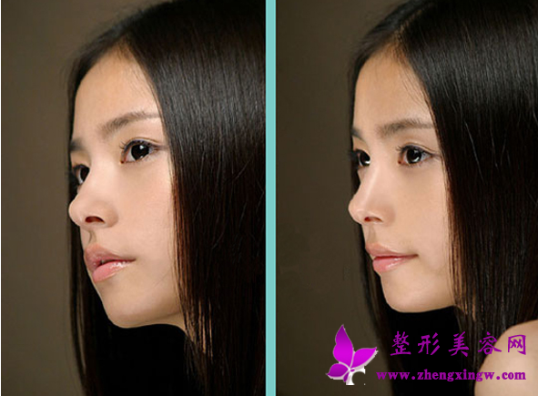  p>膨体隆鼻整形术,是 a href="#" data-lemmaid="1107603">鼻子整形