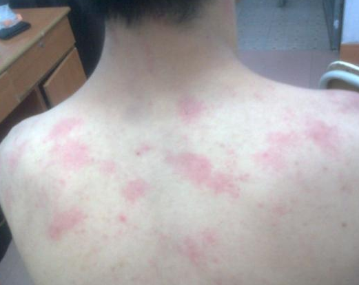 为什么会患上胆碱能性荨麻疹