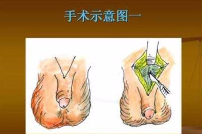 data-lemmaid="468105">阴茎 /a>增粗术是一种增粗阴茎的手术,要求为