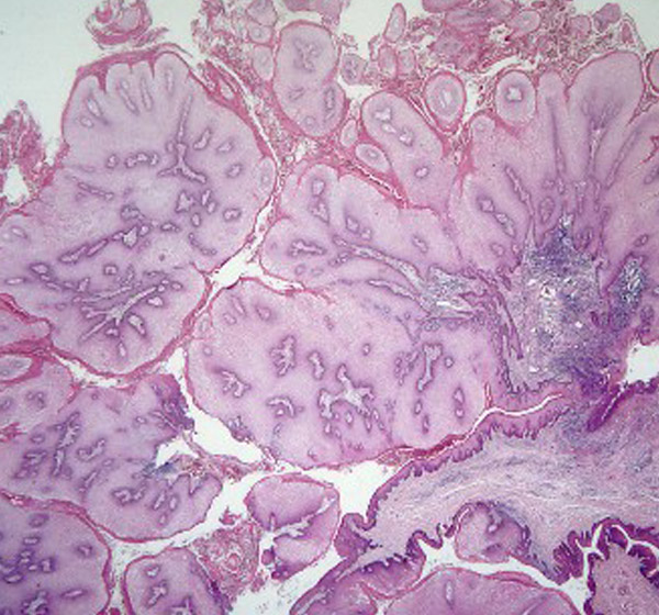  p data-id="gnbqyolafj">疣病是临床上较常见的一种病毒感染性皮肤病