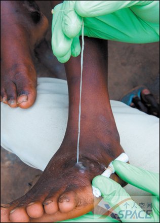  p>麦地那龙线虫 dracunculus medinensis,是唯一的主要由饮用水传播