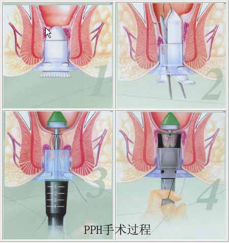  p data-id="spr6hqadgbwf">微创pph技术,又称为"痔上黏膜环切术",这