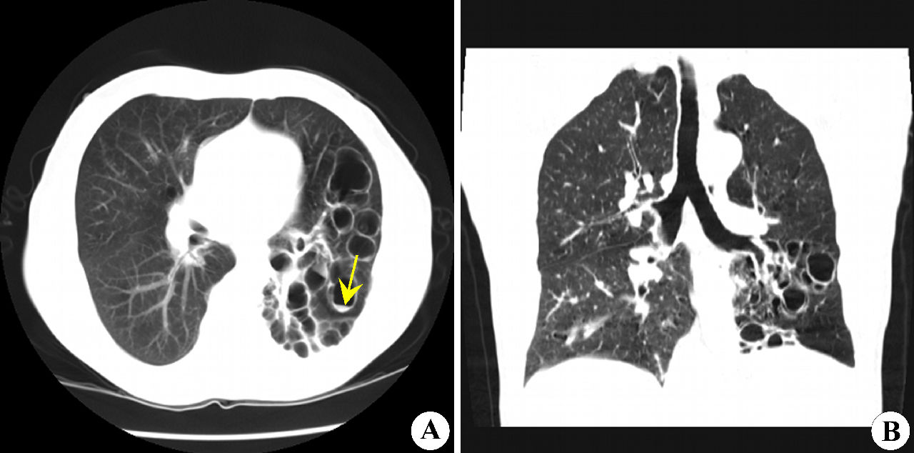 先天性囊性支气管扩张