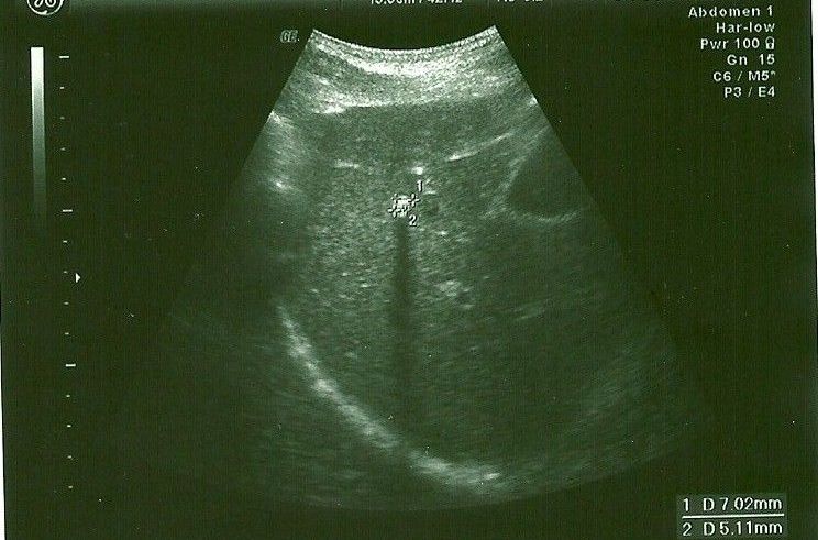  p>肝内钙化灶指在b超或 ct图像上肝脏内出现类似结石一样的强回声或