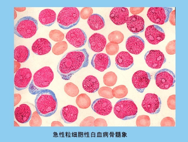 急性粒细胞白血病