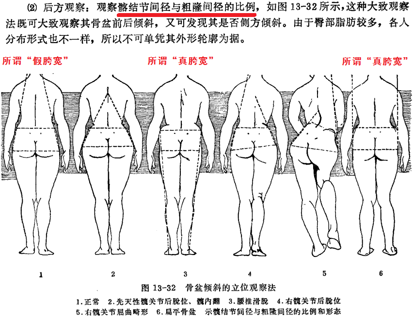 data-lemmaid="16934059">人体测量 /a>中髂宽即 a target="_blank"